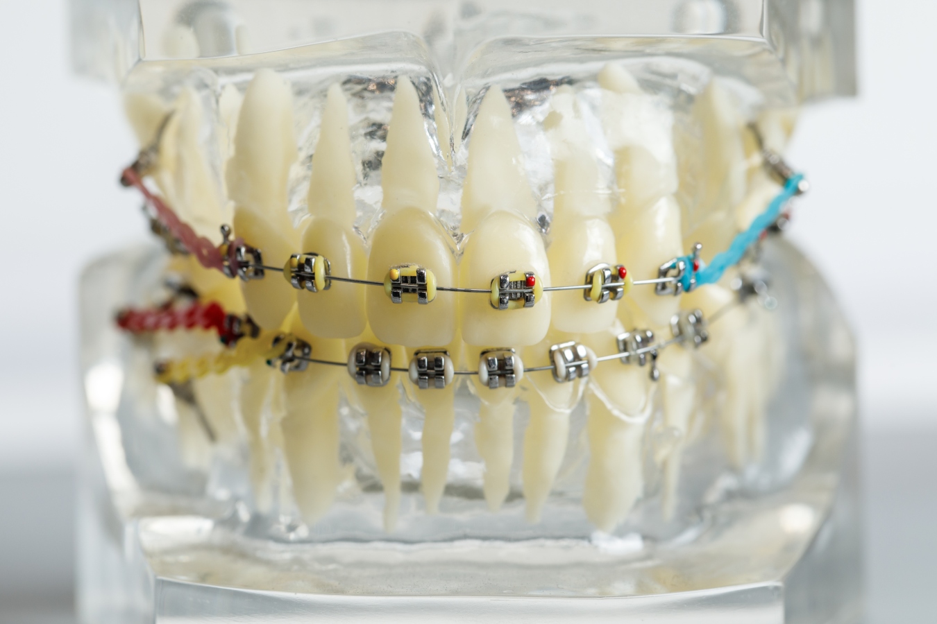 Braces in Wilmette, IL
